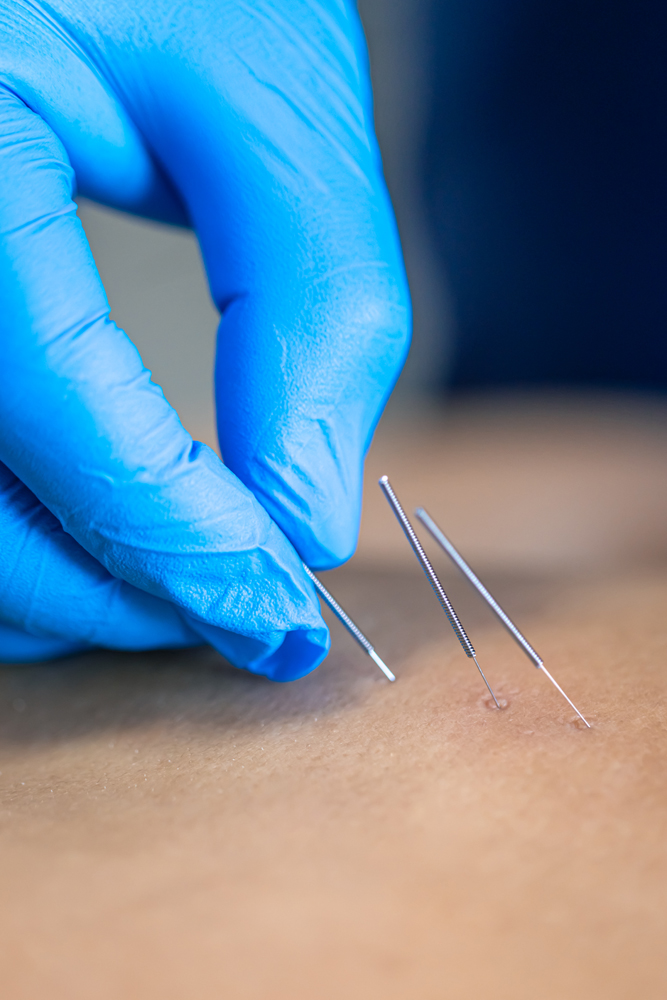 Close up of a needle and hands of physiotherapist doing a dry needling.